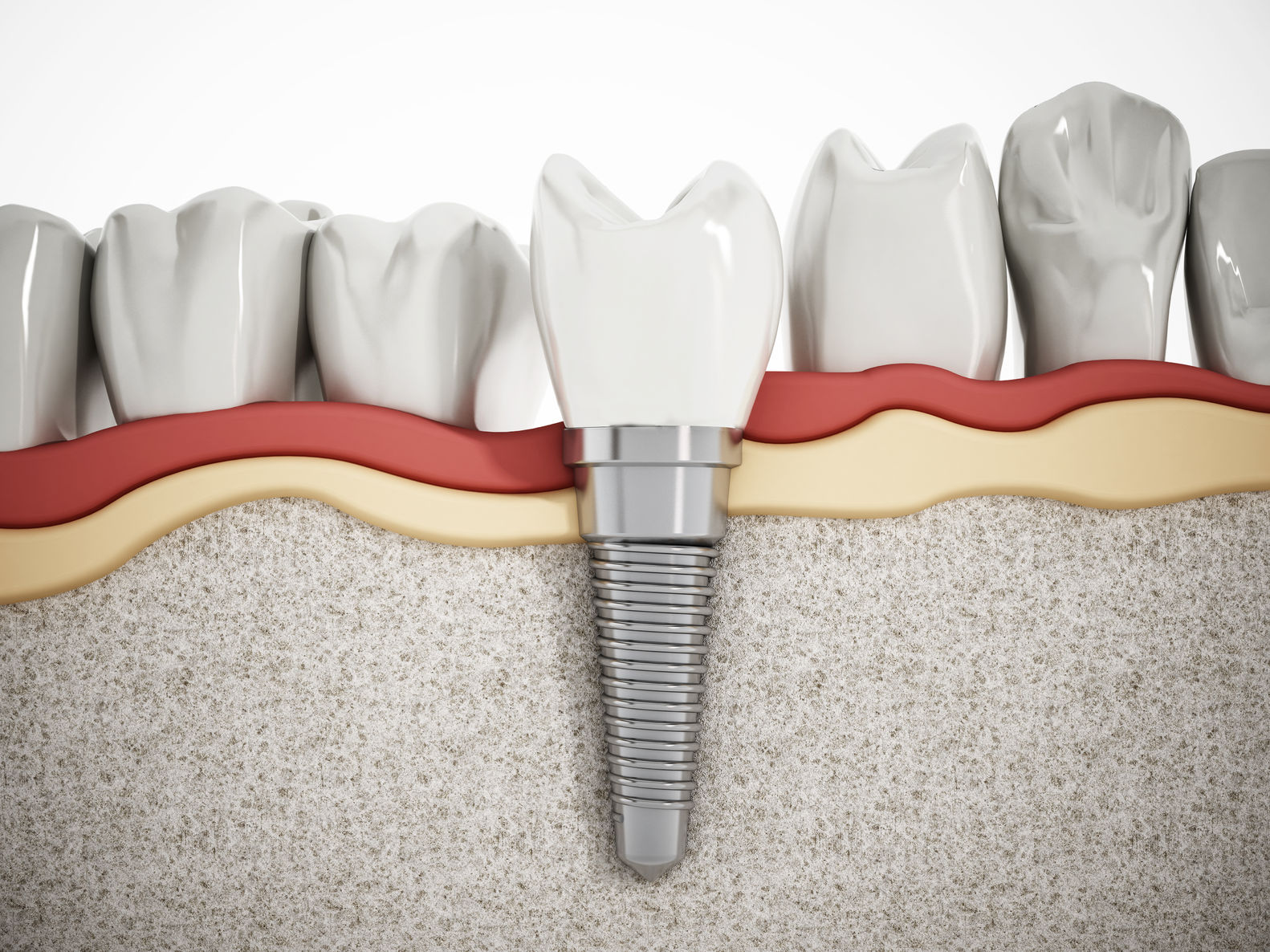 ¿Pueden Dar Problemas Los Implantes Dentales?