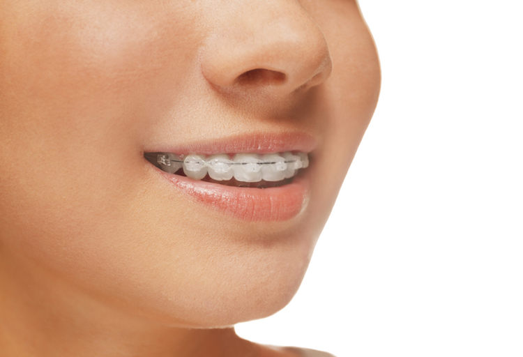 ¿Qué son los Brackets de Zafiro? Ortodoncia