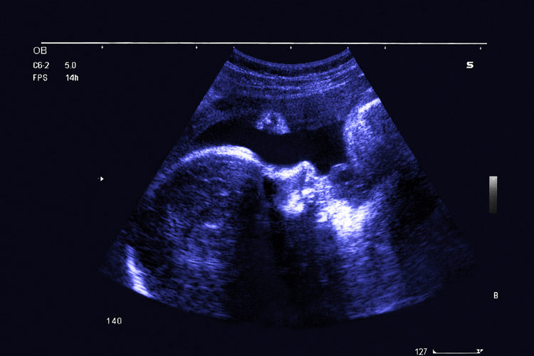 El triple screening en los tratamientos de Fecundación In Vitro