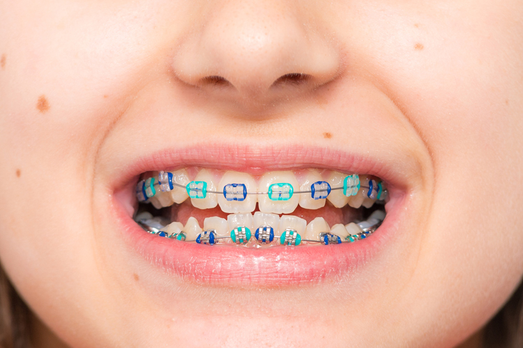 Ortodoncia en niños: ¿espero a que le salgan los dientes definitivos?