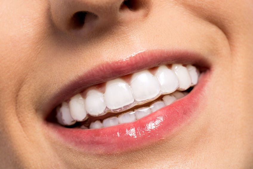 Tipos de ortodoncias